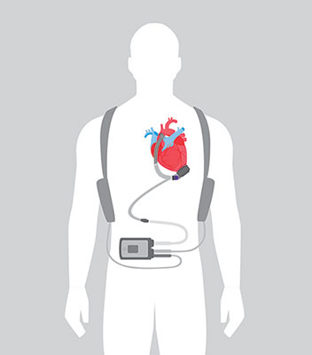HeartMate III LVAD